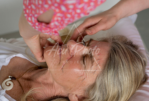 truhealthfit_acupuncture_203