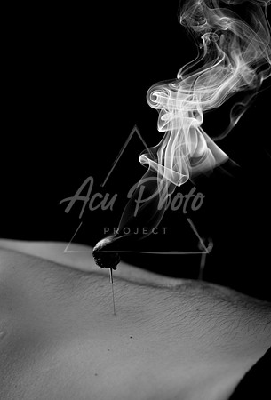 acupuncture-206
