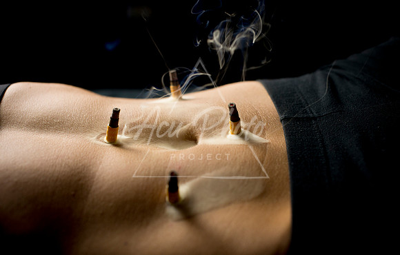 acupuncture-128