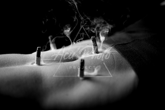 acupuncture-121