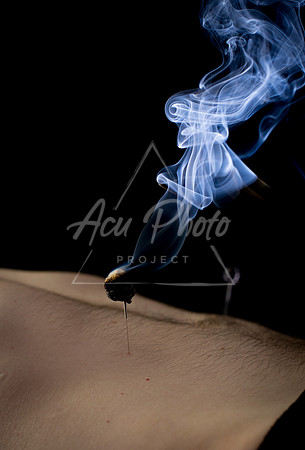 acupuncture-207