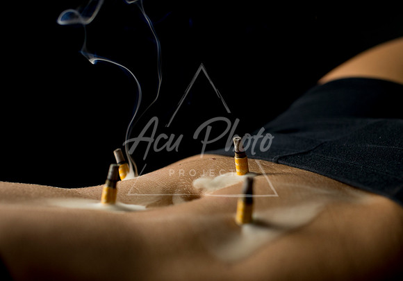 acupuncture-134