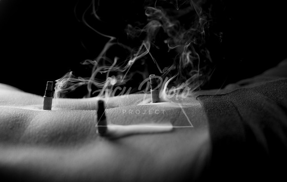 acupuncture-131
