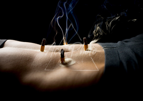 acupuncture-124