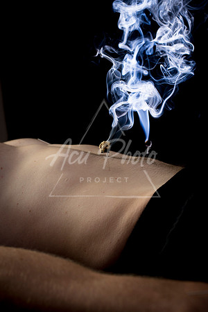 acupuncture-203