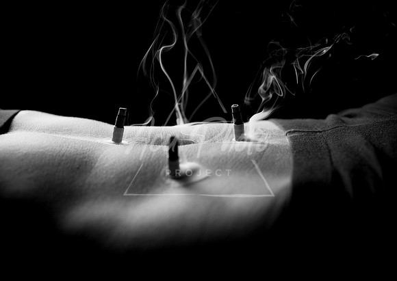 acupuncture-123