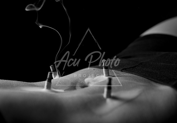 acupuncture-133