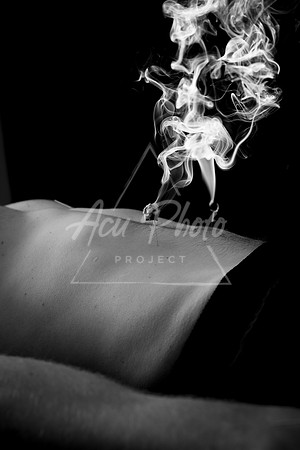 acupuncture-202