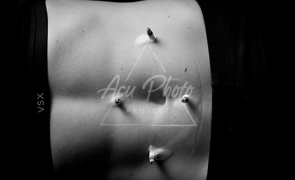 acupuncture-129