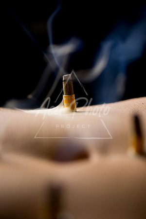 acupuncture-118