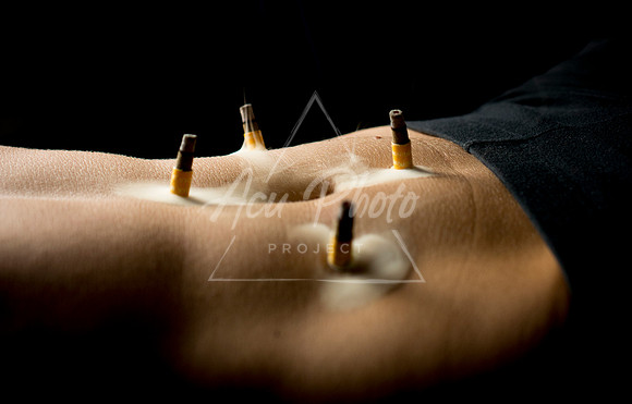 acupuncture-126