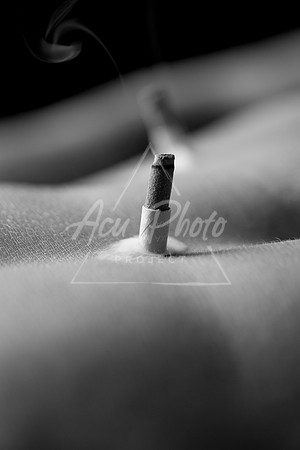 acupuncture-115