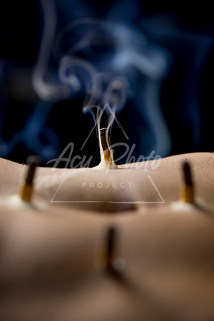 acupuncture-120