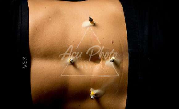 acupuncture-130