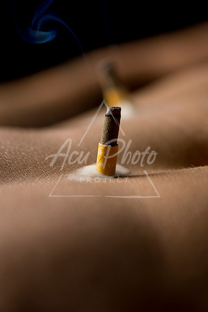 acupuncture-116