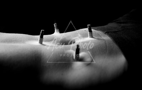 acupuncture-125
