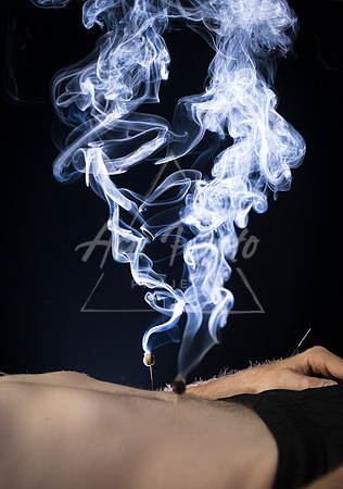 acupuncture-195